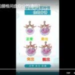 突出程度不同的腰椎间盘你分的清吗？