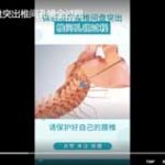 微创治疗椎间盘突出椎间孔镜全过程