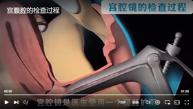 宫腹腔镜的检查过程