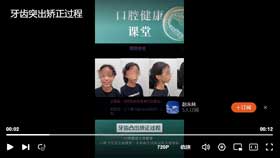 牙齿突出矫正过程