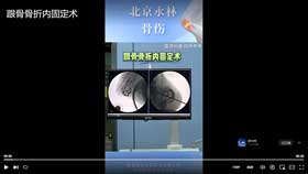 跟骨骨折内固定术