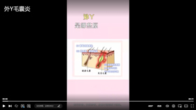 外阴毛囊炎是哪些原因导致的？